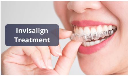 Top Benefits of Choosing Invisalign in San Diego for a Perfect Smile